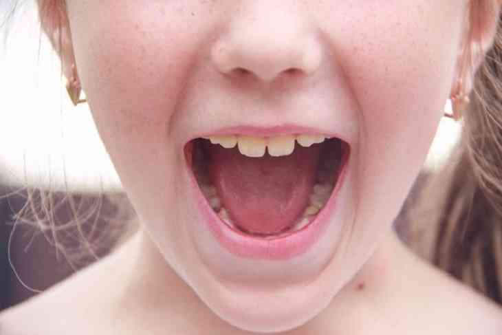 Во рту у мальчика нашли 526 лишних зубов