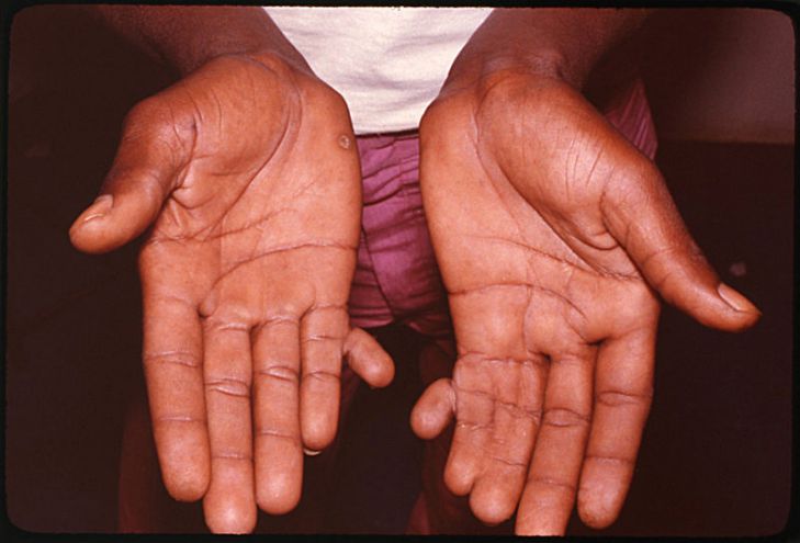 Учёные установили, что людям недостаёт шестого пальца на руках