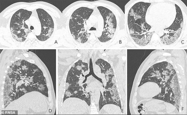 Так выглядят легкие умершего от коронавируса. В Сети появились жуткие фото